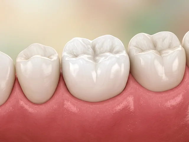 The same molar fully restored with a natural white crown
