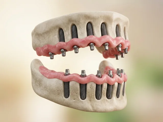 Dental implants placed as a foundation in the jaw