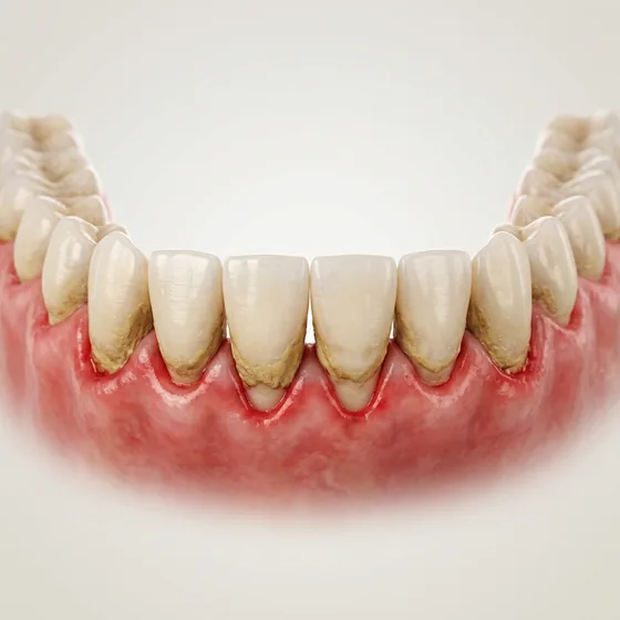 Red swollen gums with tartar and recession
