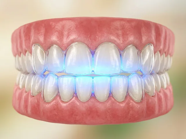A blue whitening light activating the gel