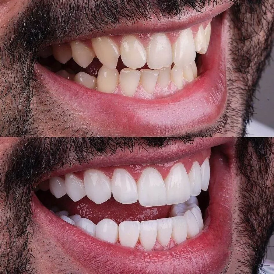 20 carillas de porcelana E-max antes y después, paciente de Just Smile Miami