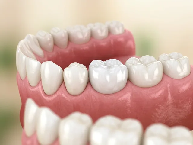 La corona terminada adherida al diente, integrándose de forma natural