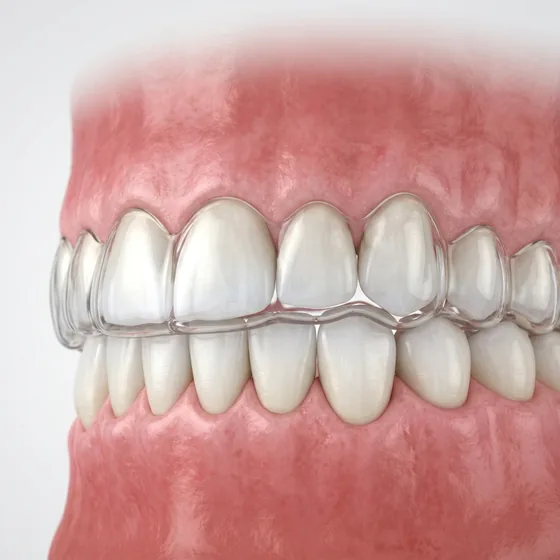 Dientes protegidos por una guarda nocturna transparente a la medida