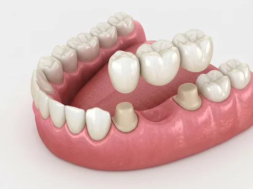 Dental bridge placed over two prepared teeth