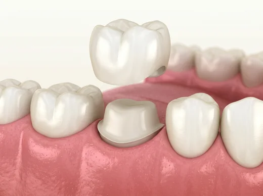 3/4 crown over a prepared tooth