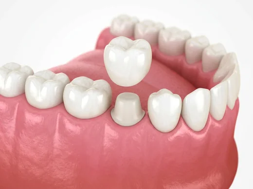 Full crown being placed on a prepared tooth