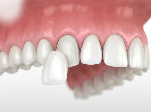 Porcelain veneer being placed on a tooth